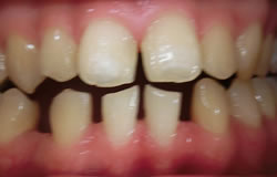 前歯の隙間をふさぐ治療の例　治療前