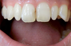 歯の形を変える治療の例　治療前