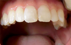 歯の形を変える治療の例　治療後
