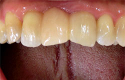 前歯をつくる治療の例　治療後
