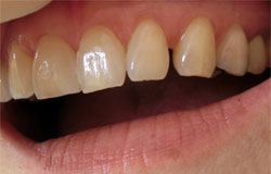 歯の隙間をふさぐ治療の例　治療前