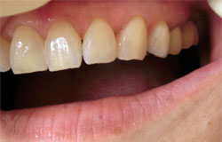 歯の隙間をふさぐ治療の例　治療後