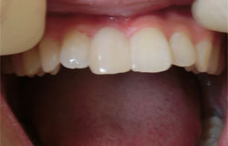 前歯をつくる治療の例　治療後
