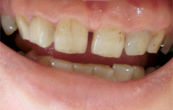 前歯の隙間をふさぐ治療の例　治療前