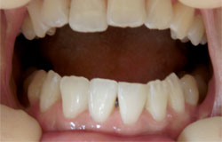 前歯の隙間をふさぐ治療の例　治療後