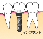 インプラントとは