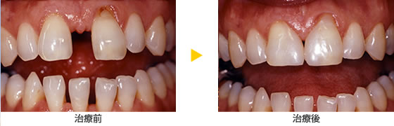 歯の隙間や欠けた歯を治したい