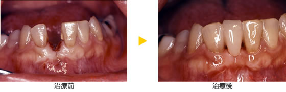 歯のない部分を補いたい