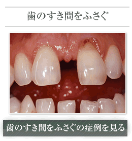 歯の隙間をふさぐ 歯の隙間をふさぐの症例を見る
