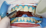 歯の表面にホワイトニング剤
