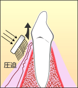 歯肉若返りブラッシング02
